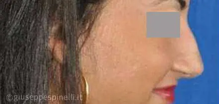 Rinoplastica foto prima dell'intervento, caso di settorinoplastica primaria per deformità del dorso e della punta nasale, Dott. Giuseppe Spinelli