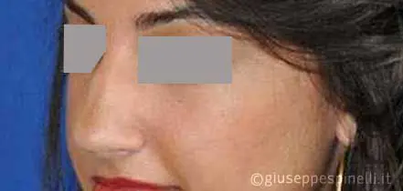 Rinoplastica foto prima dell'intervento, caso di settorinoplastica primaria per deformità del dorso e della punta nasale, Dott. Giuseppe Spinelli