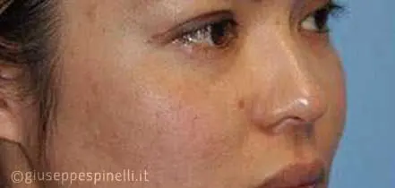 Rinoplastica foto prima dell'intervento, caso di settorinoplastica con riduzione delle cartilagini alari, Dott. Giuseppe Spinelli