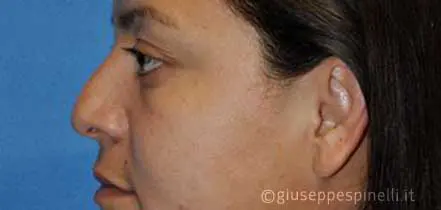 Rinoplastica foto prima dell'intervento, caso di settorinoplastica funzionale per correzione della proiezione dinamica della punta e dell'angolo naso labiale, Dott. Giuseppe Spinelli