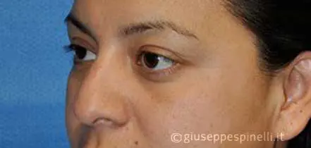 Rinoplastica foto prima dell'intervento, caso di settorinoplastica funzionale per correzione della proiezione dinamica della punta e dell'angolo naso labiale, Dott. Giuseppe Spinelli