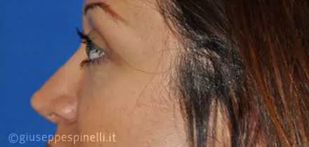Rinoplastica foto prima dell'intervento, caso di settorinoplastica riduttiva per eccesso di dorso nasale osseo e cartilagineo, Dott. Giuseppe Spinelli