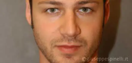 Rinoplastica foto prima dell'intervento, caso di settorinoplastica primaria per deformità del dorso, Dott. Giuseppe Spinelli