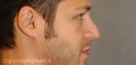 Rinoplastica foto prima dell'intervento, caso di settorinoplastica primaria per deformità del dorso, Dott. Giuseppe Spinelli