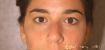 Rinoplastica foto prima dell'intervento, caso di settorinoplastica con riduzione del dorso cartilagineo, sutura delle crus laterali alari e innesto columellare autologo, Dott. Giuseppe Spinelli