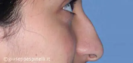 Rinoplastica foto prima dell'intervento, caso di settorinoplastica post traumatica con riposizionamento del dorso nasale e sutura della punta, Dott. Giuseppe Spinelli