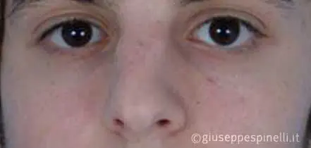 Rinoplastica foto prima dell'intervento, caso di settorinoplastica post traumatica con riposizionamento del dorso nasale e sutura della punta, Dott. Giuseppe Spinelli