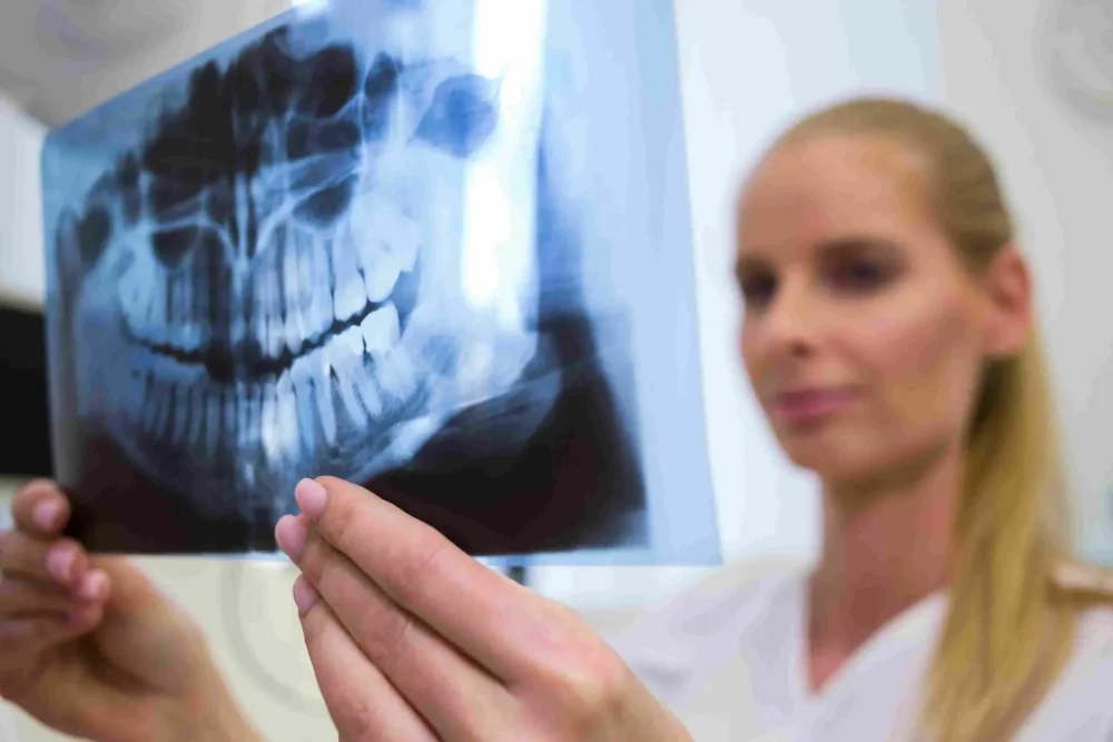 Radiografia panoramica per valutazione denti del giudizio prima dell'estrazione