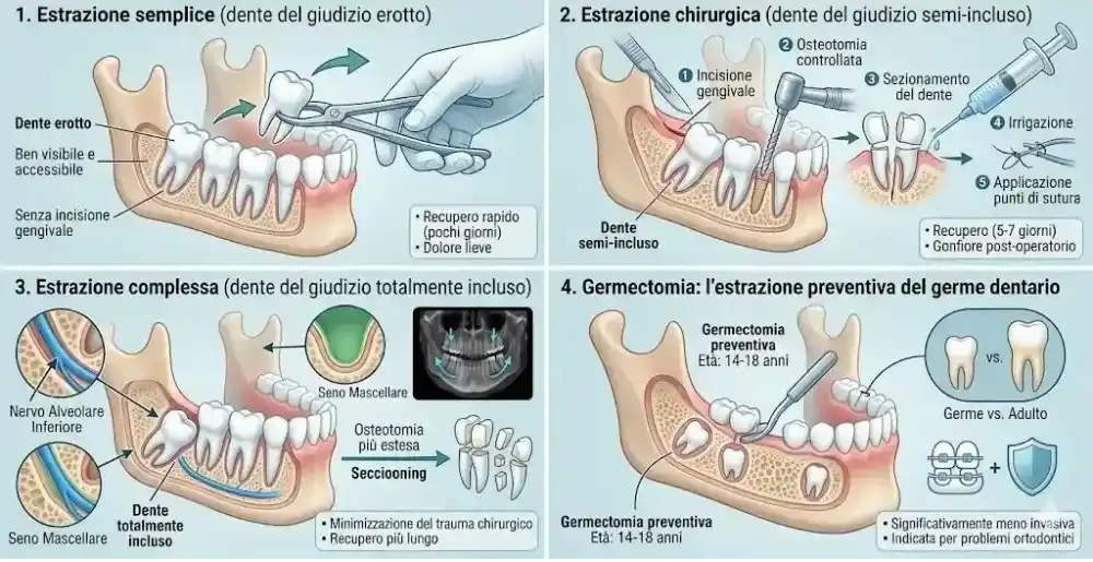 Infografica tipologie di estrazione del dente del giudizio: estrazione semplice, chirurgica, complessa e germectomia