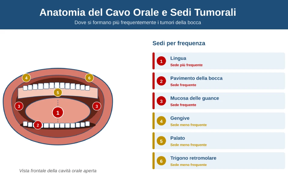 Anatomia del cavo orale con le sei sedi tumorali numerate: lingua (la più frequente), pavimento, mucosa guance, gengive, palato, trigono retromolare