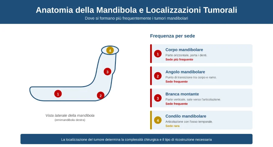 Anatomia della mandibola con le quattro localizzazioni più frequenti del tumore mandibolare: corpo, angolo, branca montante e condilo